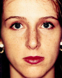 Case # 5 after photo