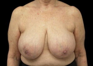 Case # 13 before photo