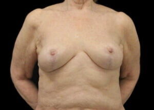 Case # 13 after photo