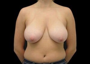 Case # 15 before photo