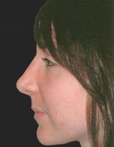 Case # 2 after photo