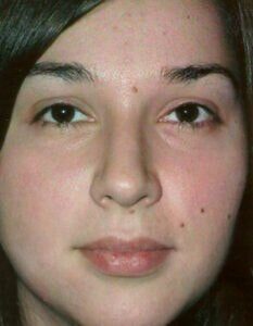 Case # 3 after photo