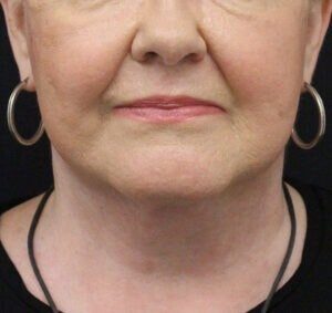 Case # 8 after photo