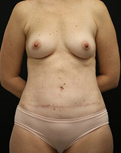 Case # 6 after photo