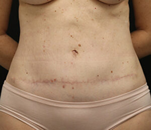 Case # 18 after photo