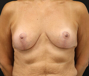 Case # 6 after photo