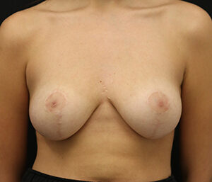 Case # 26 after photo