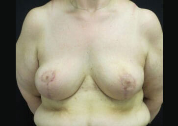 Case # 18 after photo