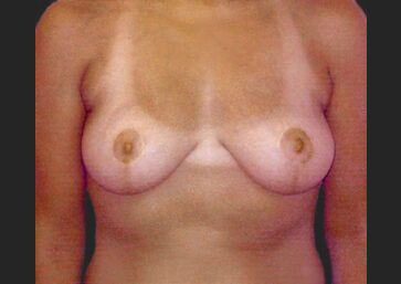 Case # 20 after photo